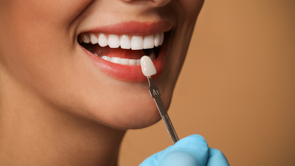 5 consejos sobre cómo cuidar las carillas dentales | Dental Estetic