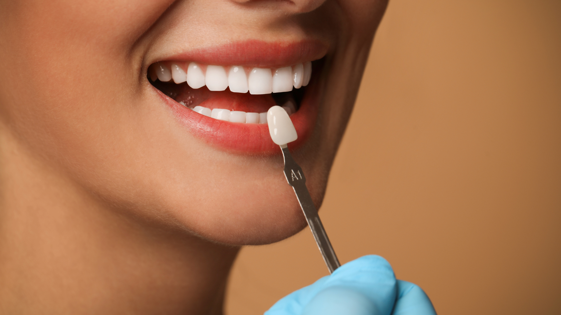 5 consejos sobre cómo cuidar las carillas dentales | Dental Estetic