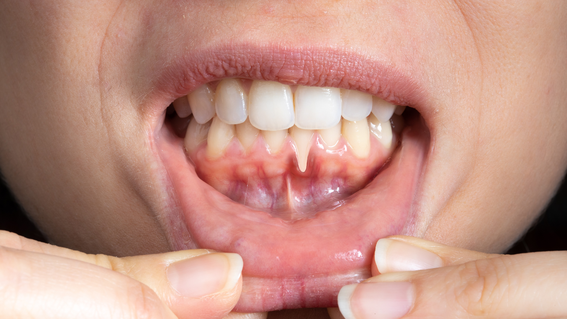 ¿Se puede curar completamente la periodontitis? | Dental Estetic