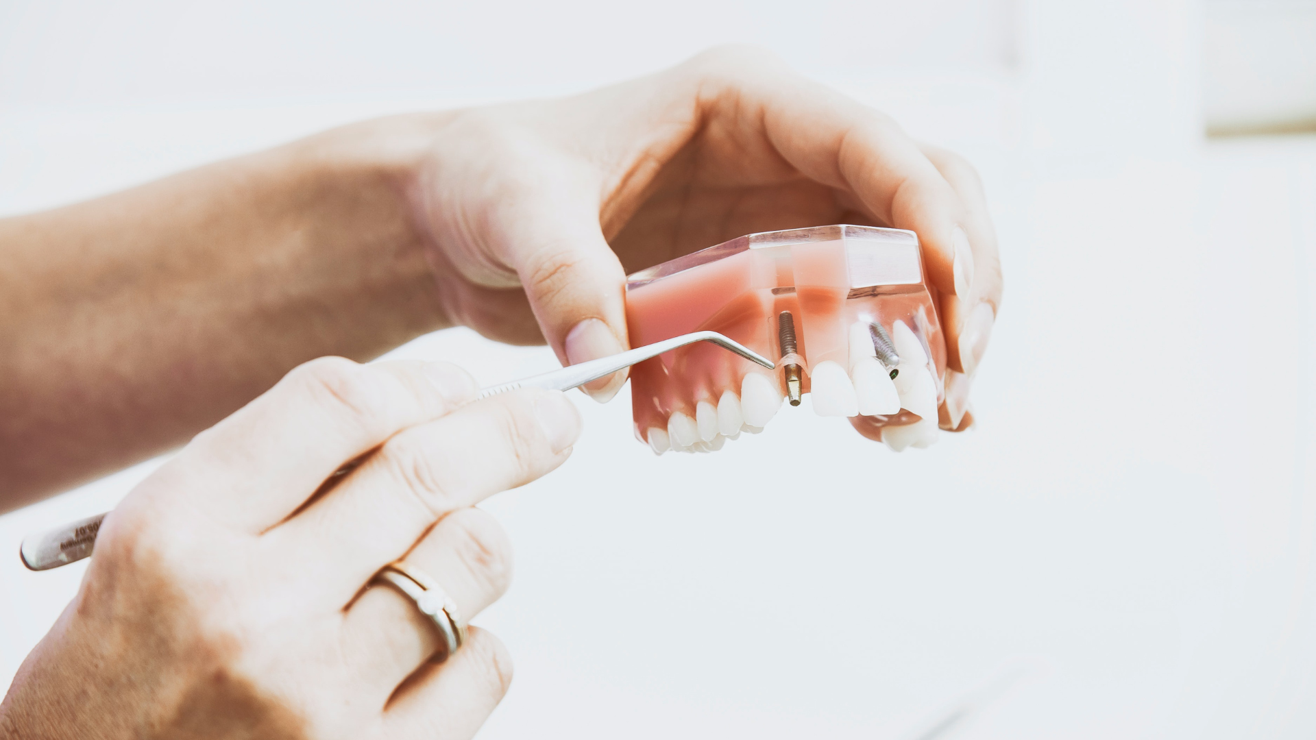 ¿Merece la pena ponerse un implante dental? | Dental Estetic
