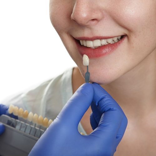 Transforma tu sonrisa con carillas dentales en Aguadulce y Roquetas
